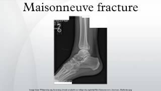 Maisonneuve fracture