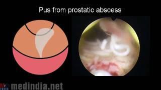 Prostatic Abscess