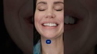 VENEER TRY ON  | Smile Texas #smiledesign #veneers #porcelainveneers #dentist #dentalveneers