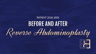 Reverse Abdominoplasty {Patient 2018-1005} Before & After