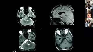 Versatility of the Lateral Supracerebellar Approach | Neurosurgical TV