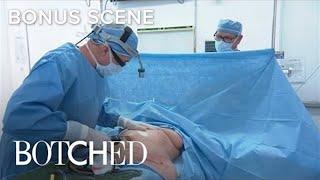 "Botched" Doc Performs Liposuction Surgery | E!