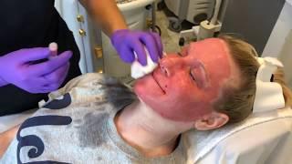 TRL Laser For A Dramatic Skin Rejuvenation