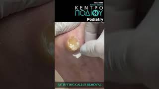 Satisfying Callus Removal|Κέντρο Ποδιού Podiatry|Podiatrist|Podologia|Podologa|Podologos|Feet|Foot