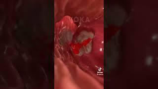 Oshqozon yara kasalligi. Stomach ulcer disease. #anatomiya #imed #doktorischanov #tiktok #shorts