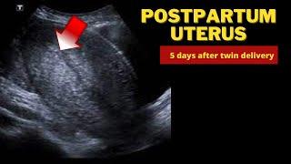 Postpartum Uterus 5th day after Twin delivery || Ultrasound Case