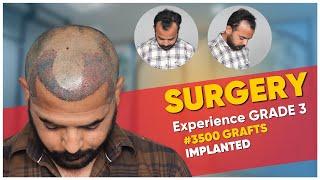 Hair Transplant in Surat | Best Results & Cost of Hair Transplant in Surat