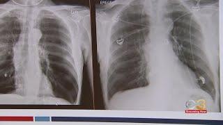 New treatment for people with COPD, emphysema at Penn Medicine