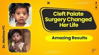 Cleft Palate Surgery In India Changed Her Life - Amazing Results | Dr Mathew PC