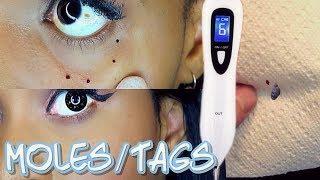 MOLES & SKIN TAGS FALL OFF WITH AT HOME DARK SPOT REMOVAL PEN!