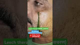 Melasma treatment #ayurveda#pigmentation#leechtherapy#skincare#skin#panchakarma#viralvideo#shorts#mp