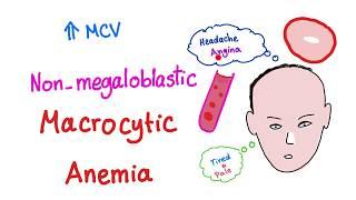 Non-megaloblastic Macrocytic Anemia