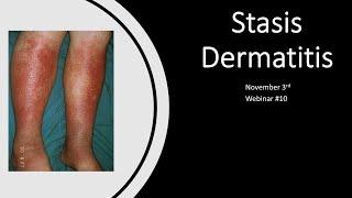 Exosomes Webinar #10 - Stasis Dermatitis