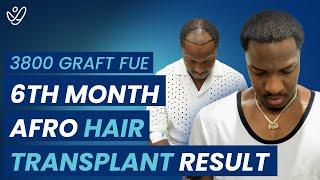 3800 Graft FUE: 6-Month Afro Hair Transplant Before and After