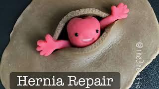 Playdough Surgery - Open Inguinal Hernia Repair (Lichtenstein tension-free mesh repair)