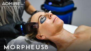 The Power of Morpheus8 at AdmireMD Skin Clinic in Scottsdale, Arizona!