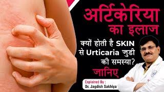 Urticaria (Hives) Causes, Symptoms & Treatment ( In Hindi ) | Dr. Jagdish Sakhiya Skin Clinic