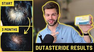 How Dutasteride Prevents my Hair Loss