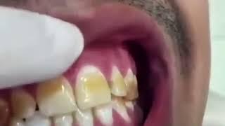 Dental Fluorosis