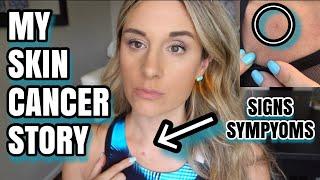 MY SKIN CANCER STORY - MY SIGNS AND SYMPTOMS!