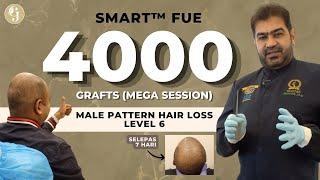 ‘Mega Session’: 4,000 Graf | 7 Hari Selepas SMART™ FUE Hair Transplant Malaysia