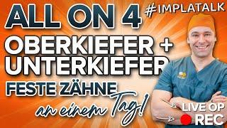 Feste Zähne an 1 Tag: All on 4 im Oberkiefer + Unterkiefer mit 8 Implantaten! LIVE OP 