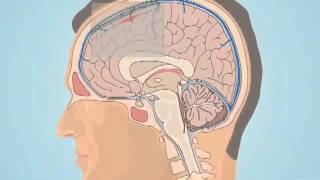 Understanding Subarachnoid Hemorrhage