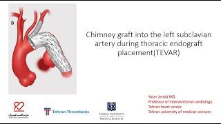 Thoracic endovascular aortic repair (TEVAR) wth chimney of subclavian artery