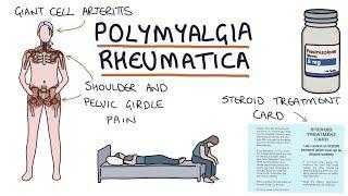 Polymyalgia Rheumatica: Visual Explanation for Students