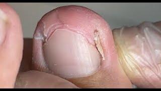 Best ingrown nail removal