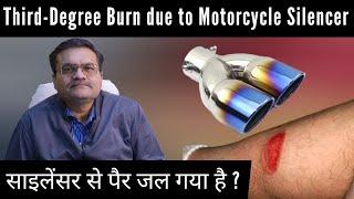 Silencer Burn ? | Motorcycle के साइलेंसर से जलने पर होता है थर्ड डिग्री बर्न, इसे हल्के में न ले ।