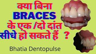 क्या बिना ब्रेसेस के एक /दो दांत सीधे हो सकते हैं-Align front teeth without braces-Dr.Praveen bhatia