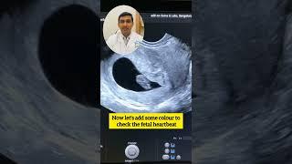 What can you see in an early pregnancy scan?|Dr. Sunil Kumar G S| #earlypregnancy #shorts #pregnant