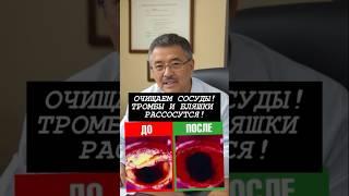 ЧУДО СРЕДСТВО ДЛЯ ЧИСТКИ СОСУДОВ! ИЗБАВЛЯЕМ ОТ АТЕРОСКЛЕРОЗА!