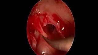 Ossicle movement check with endoscope _ Dr Nirmal Patel