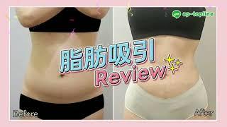 【狎鴎亭トップライン】 大容量脂肪吸引 REVIEW!