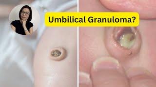 Umbilical Granuloma: Treatment and Taking care of baby's umbilical cord | Dr. Kristine Alba Kiat
