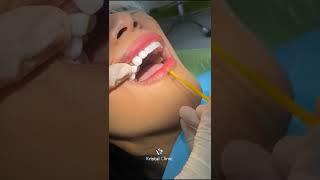 Hollywood smile makeover - dental teeth veneers