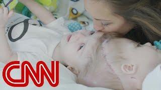 Rare surgery to separate conjoined twins