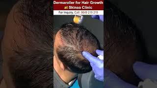 Dermaroller for hair growth #dermaroller #dermarollerforhairgrowth #hairgrowth #dermarollerforhair