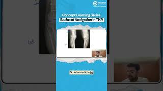 Concept Learning Series | Basics of Navigation in TKR By Dr. Vishal M Huggi | Orthopedic Residency