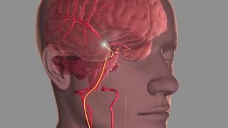 Mechanical Thrombectomy