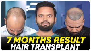 Hair Transplant in Coimbatore | Best Results & Cost of Hair Transplant in Coimbatore