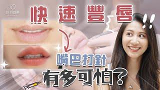 玻尿酸豐唇分享！嘴上打針有多痛？多久自然？效果如何｜依心唯美 謝東穎醫師