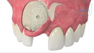 maxgraft® bonebuilder in maxilla including semi-pillar incisions by Dr. Dr. O. Blume