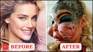 Famous Celebrities Unrecognizable After Plastic Surgery Gone Wrong | Then and Now 2024