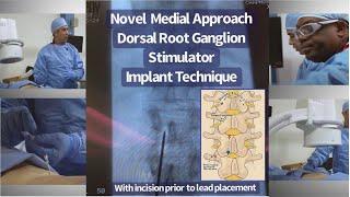 The Ipsilateral Medial Approach for DRG-S Lead Placement with Dr. Ken Chapman