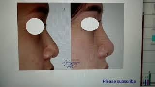 Operasi plastik hidung sebelum sesudah. Rhinoplasty case.