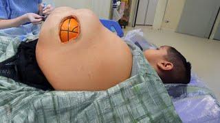 a ball got stuck in his belly..