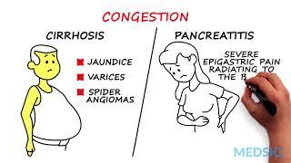 Splenomegaly: Remember the 3 primary causes with CIP